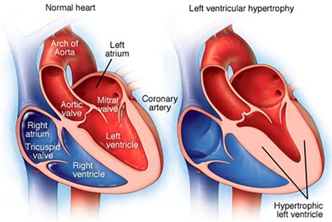 Left Ventricular Hypertrophy (LVH) 